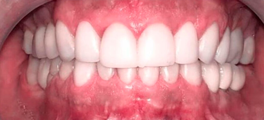 Resinas Estéticas e Prótese Sobre Implantes | Prótese Sobre Dentes e Implantes