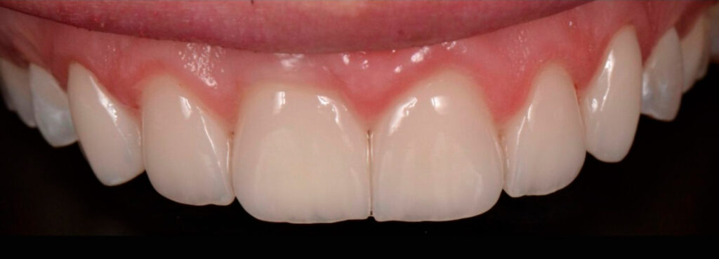 Lentes de Contato em Porcelana | Prótese Sobre Dentes e Implantes