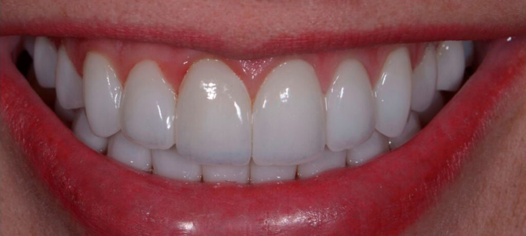 Implantes e Prótese Fixa Sobre Implantes (Protocolo) | Prótese Sobre Dentes e Implantes