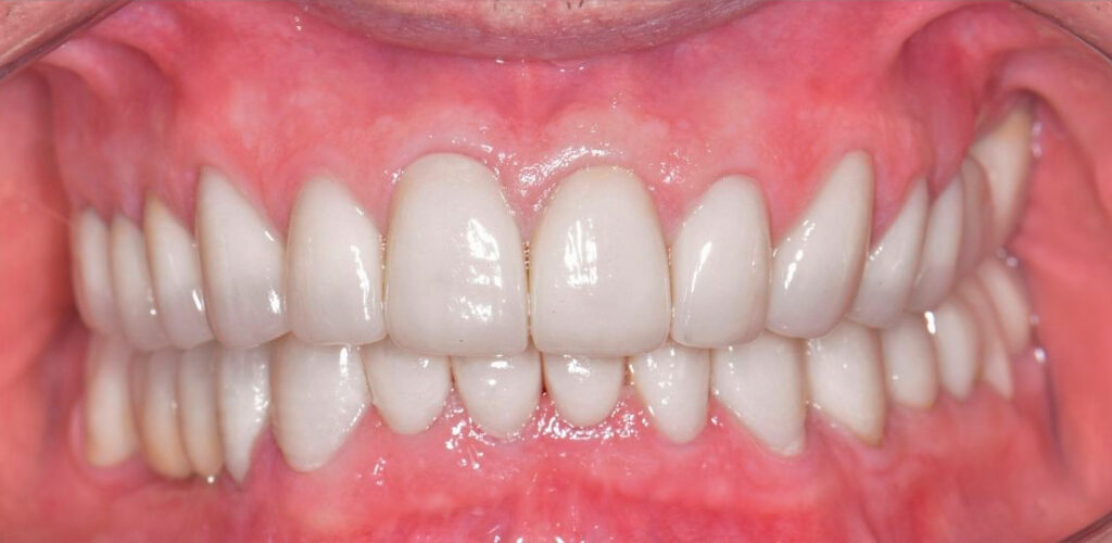 Coroas Sobre Implantes e Sobre Dentes | Prótese Sobre Dentes e Implantes