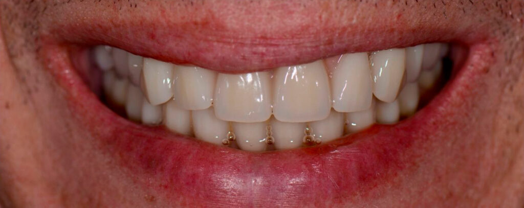 Implantes e Protocolo Sobre Implantes | Prótese Sobre Dentes e Implantes