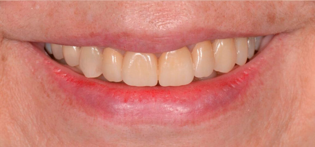 Coroas em Cerâmica | Prótese Sobre Dentes e Implantes